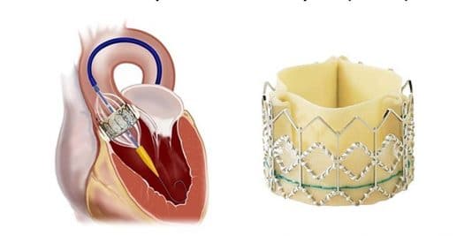 Image de l'implantation d'une bio prothèse aortique par TAVI