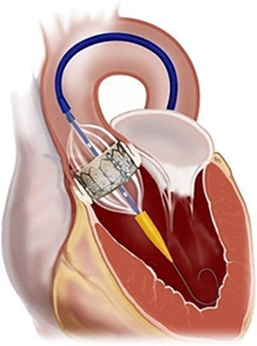 Valve aortique - C.I.I.C - Centre Interventionnelle et Imagerie Médicale